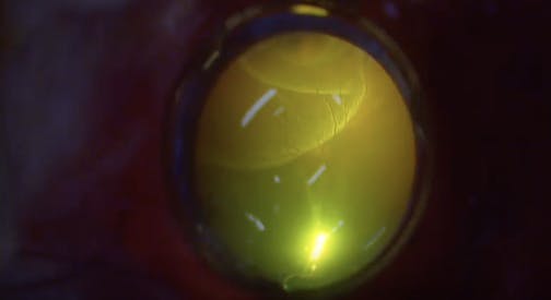 Chandelier-Assisted Scleral Buckling With Subretinal Fluid Drainage