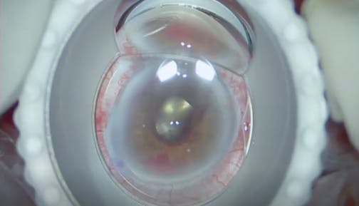 Combined Vitrectomy and Glaucoma Surgery