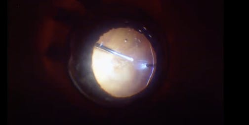 Retinal Detachment in a Highly Myopic Eye With Posterior Breaks