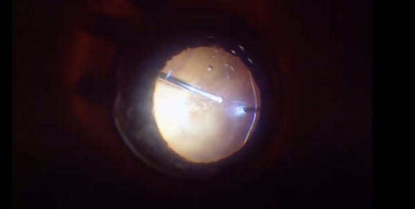 Retinal Detachment in a Highly Myopic Eye With Posterior Breaks thumbnail