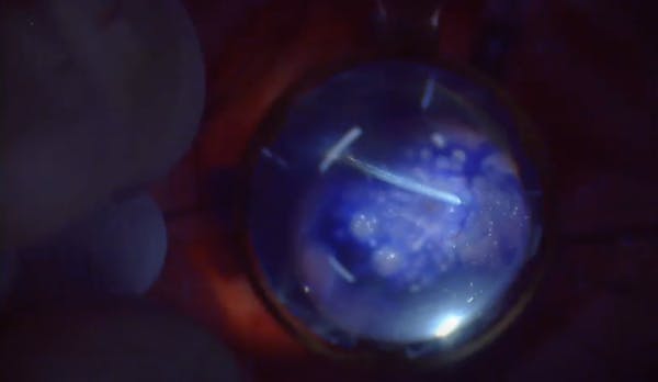Cryopexy for Secondary Retinal Detachment thumbnail