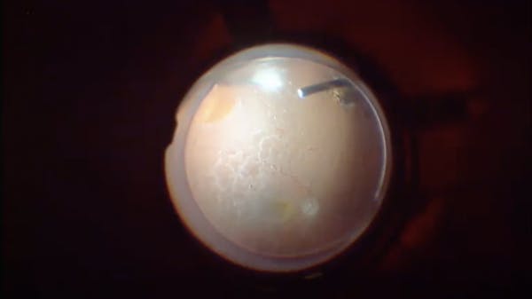 Pseudophakic Retinal Detachment thumbnail