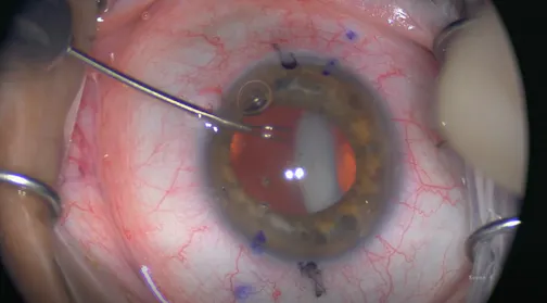 Subluxated Toric IOL With Pellucid Marginal Degeneration