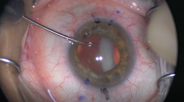 Subluxated Toric IOL With Pellucid Marginal Degeneration thumbnail