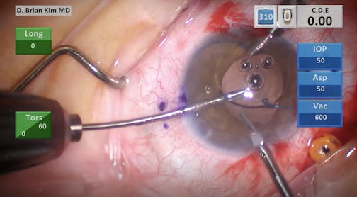 Kim Modified Yamane Technique Using Delicate PMMA Haptic Sensar IOL