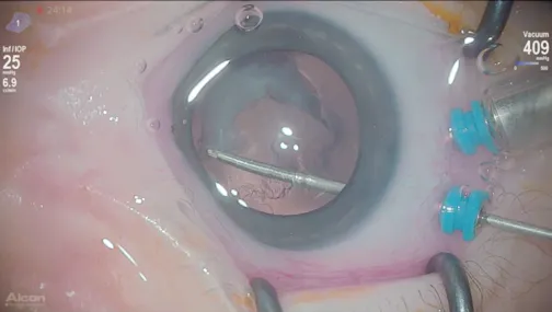 3D Surgery: Congenital Cataract and Down Syndrome