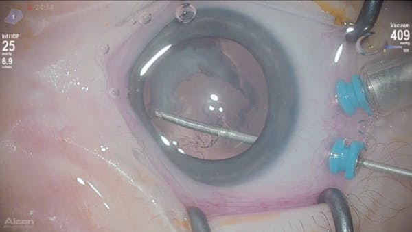 3D Surgery: Congenital Cataract and Down Syndrome thumbnail