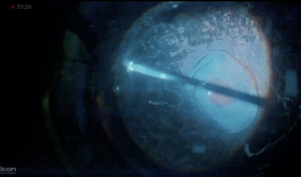 IOL Removal thumbnail