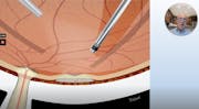 Surgery Under the Retina