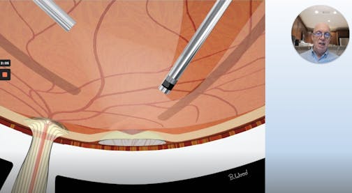 Surgery Under the Retina