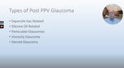 Post-Vitrectomy Glaucoma