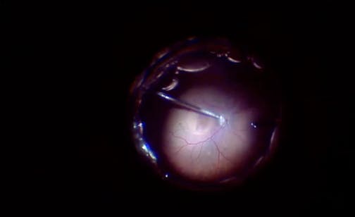 Surgery for Refractory Macular Hole