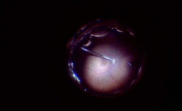 Surgery for Refractory Macular Hole thumbnail