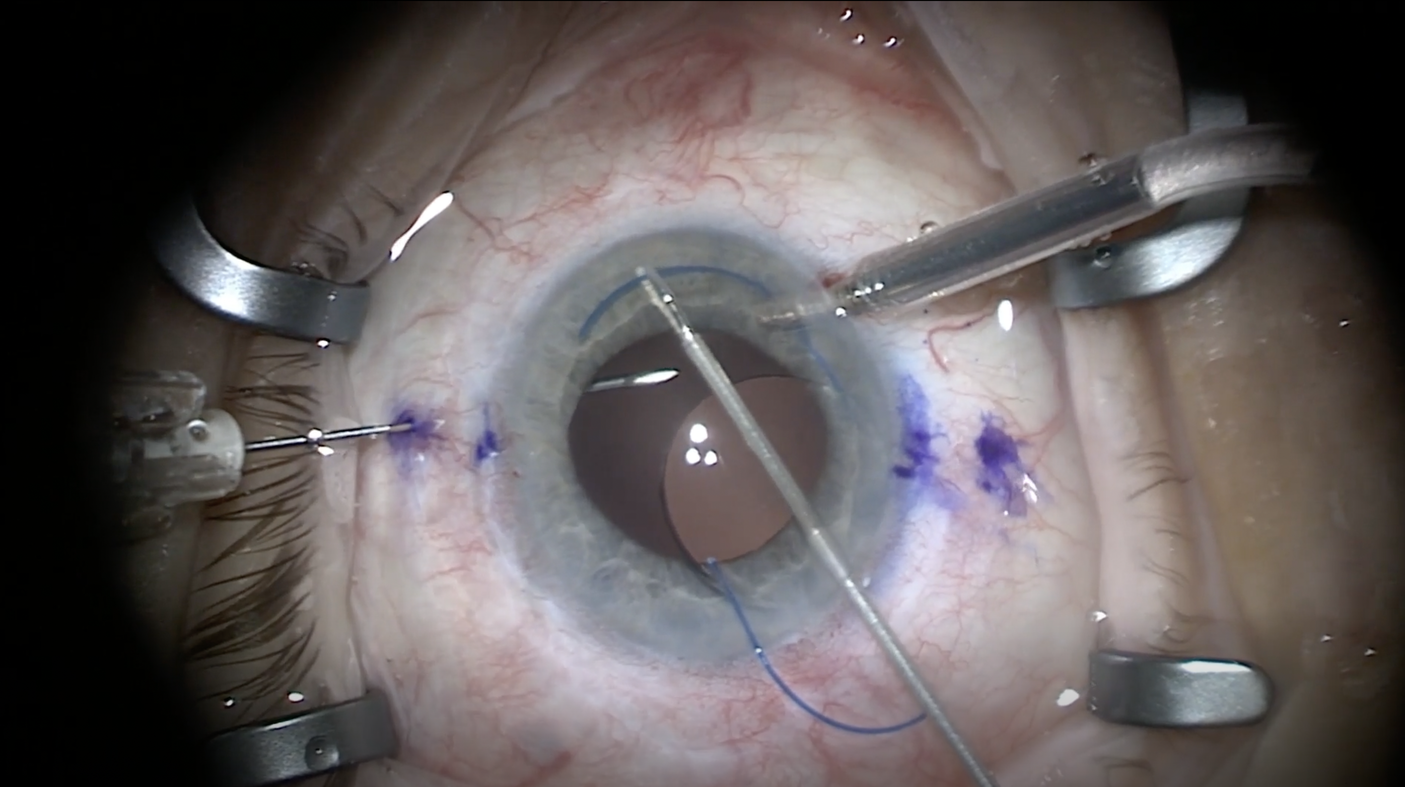 pellucid marginal degeneration review of optometry pellucid marginal degeneration review of optometry