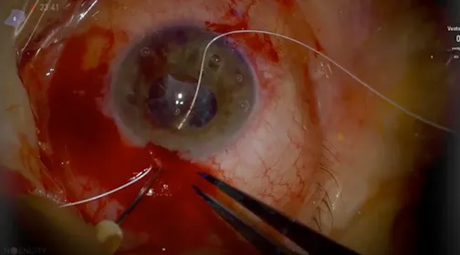 Scleral Fixation of a Subluxated IOL With Gore-Tex Sutures