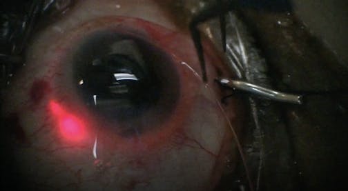 Technique for Ab Interno Canaloplasty
