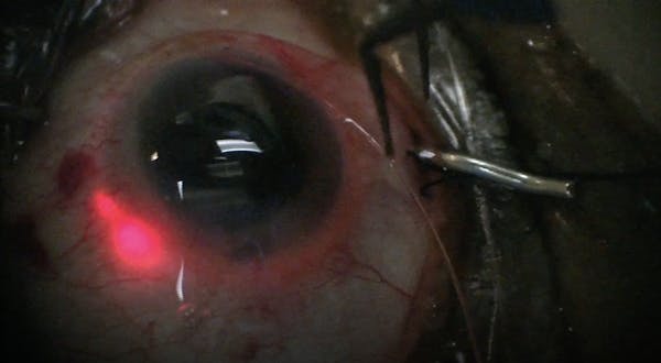 Technique for Ab Interno Canaloplasty thumbnail