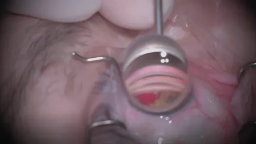 Hydrus Removal and Reposition