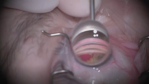 Hydrus Removal and Reposition thumbnail