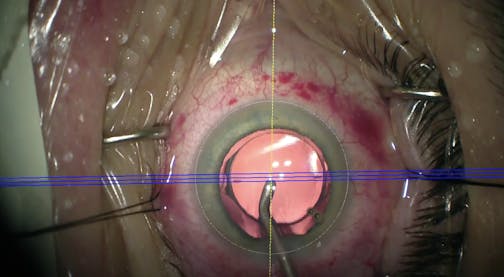 Bidirectional Toric IOL Rotation
