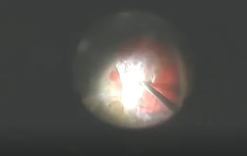 Management of Diabetic Tractional Retinal Detachment