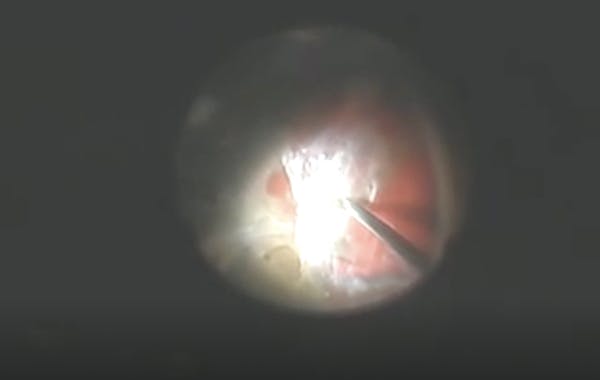 Management of Diabetic Tractional Retinal Detachment thumbnail