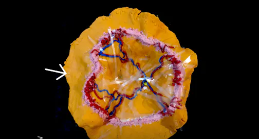 Retinopathy of Prematurity