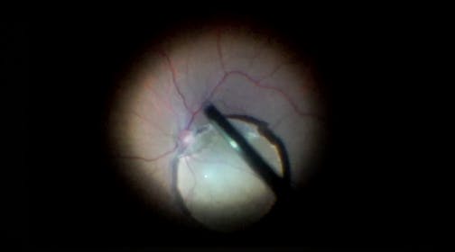 Dislocated Lens and Secondary Retinal Detachment