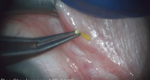 Dextenza Insertion