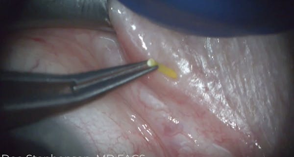 Dextenza Insertion thumbnail