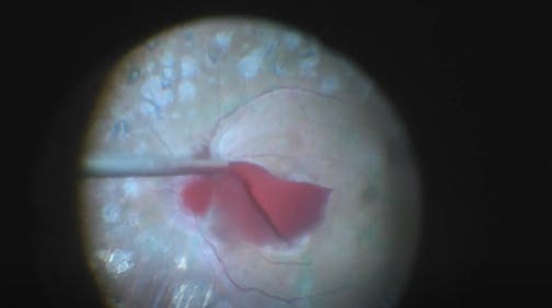 Plasma-Assisted Macular Hole Closure