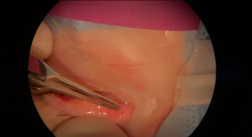 Intracanalicular Dexamethasone Insert Placement