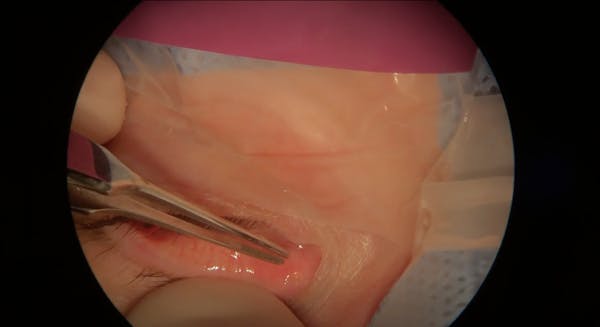 Intracanalicular Dexamethasone Insert thumbnail
