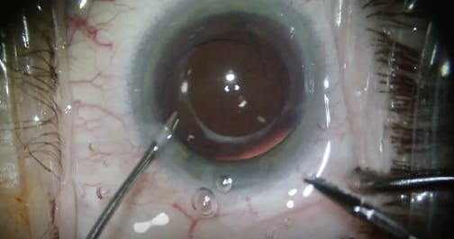 Light Adjustable Lens Explantation