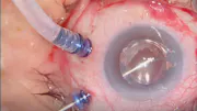 CTR Repositioning After Complicated Cataract Surgery