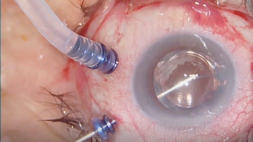 CTR Repositioning After Complicated Cataract Surgery