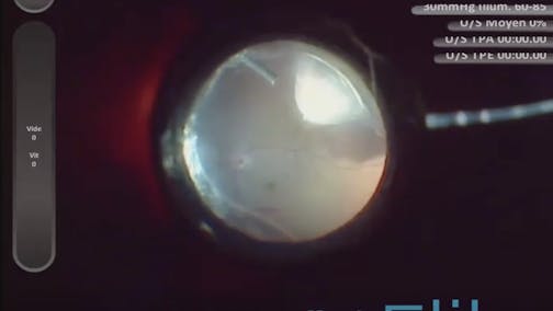 Hemorrhagic Choroidal Detachment