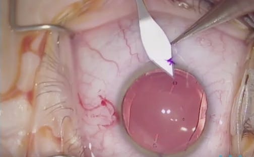 Implantable Collamer Lens for Hyperopia and Astigmatism