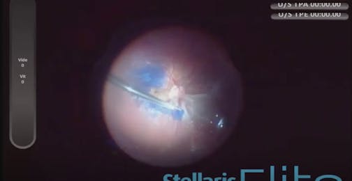 Retinal Detachment in Myopic Eye With Macular Hole