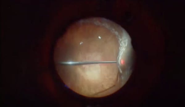 Retinal Detachment Due to Peripheral Retinoschisis Dehiscence thumbnail