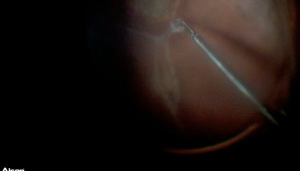 Removal of Subretinal Bands Using NGENUITY 3D DAVS thumbnail
