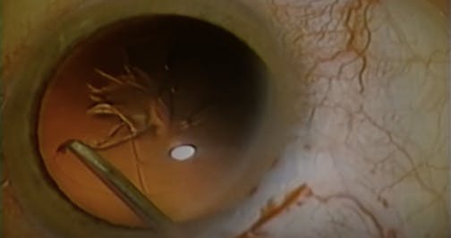 Hyperopic Clear Lensectomy, Astigmatic Keratotomy With Phaco
