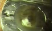 First Lasik Procedure Ever