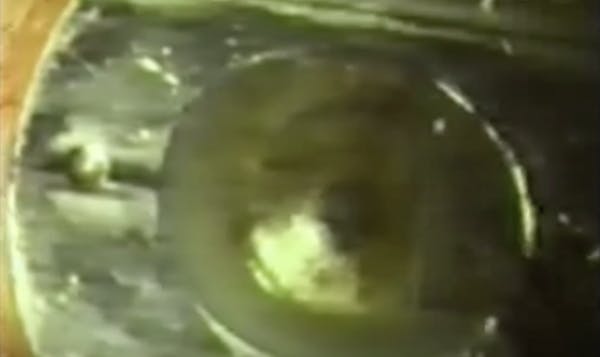 First Lasik Procedure Ever thumbnail