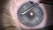 Lenticle Intrastromal Keratoplasty (LIKE)