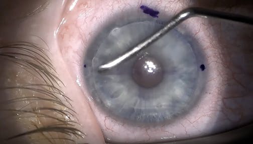 Lenticle Intrastromal Keratoplasty (LIKE)