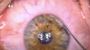 LIKE: Lasik and Intrastromal Keratoplasty