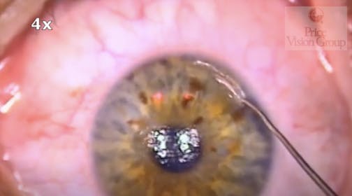 LIKE: Lasik and Intrastromal Keratoplasty