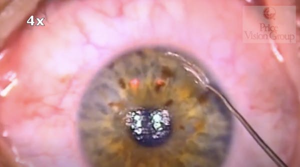 LIKE: Lasik and Intrastromal Keratoplasty thumbnail