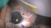 Laser Scleral Microporation (LSM) for Presbyopia